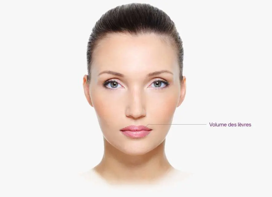 Injections pour les lèvres