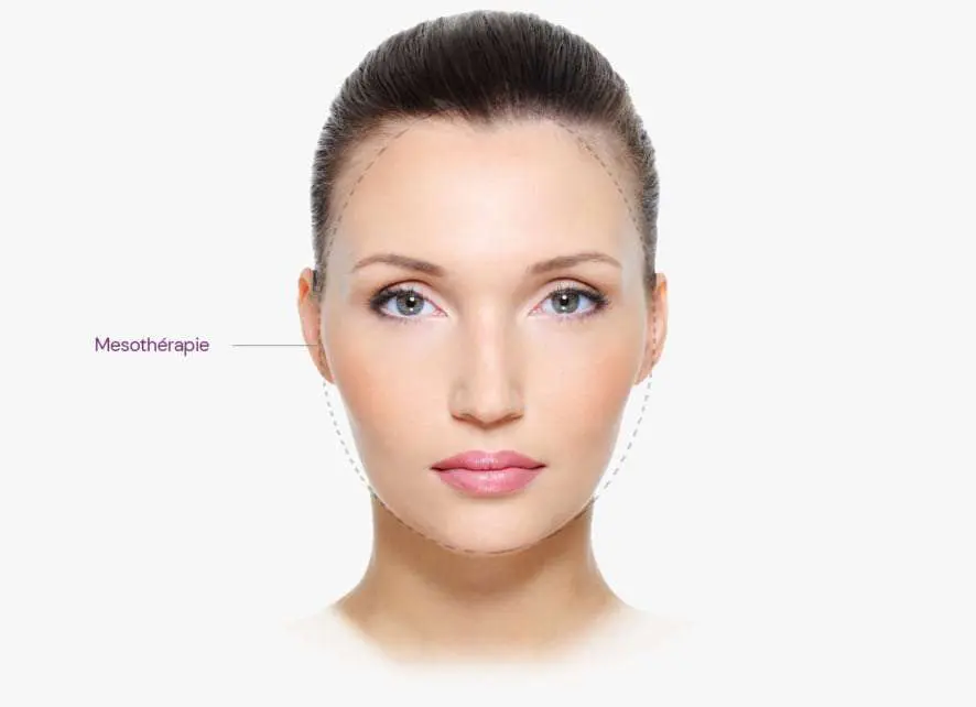 Injections pour le teint du visage