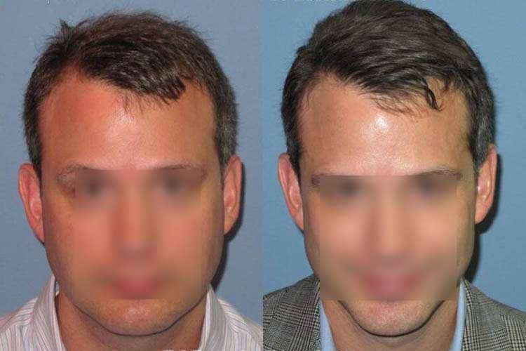 La Microgreffe F.U.E. avant - après 1