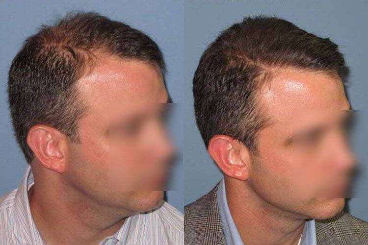 La Microgreffe F.U.E. avant - après 1