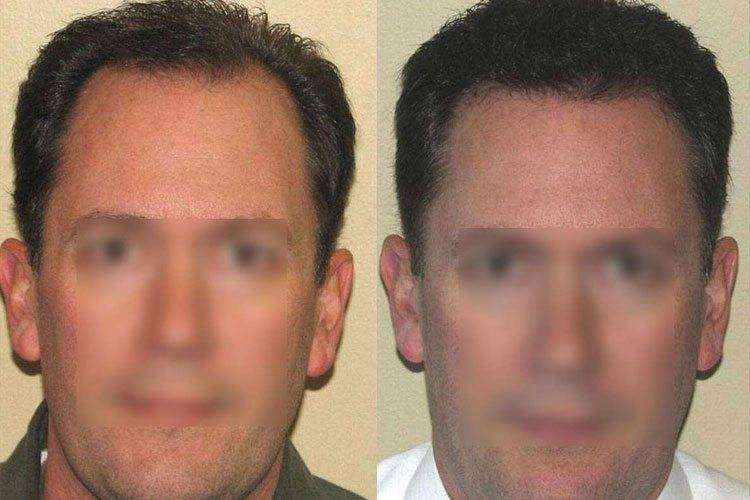 La Microgreffe F.U.E. avant - après 2