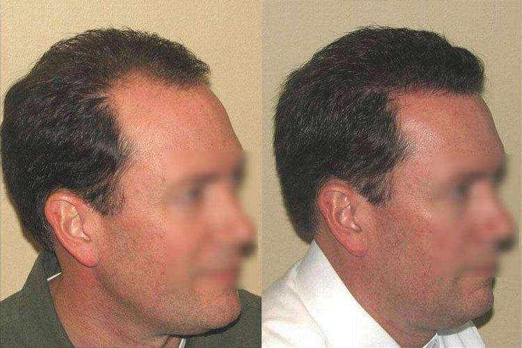 La Microgreffe F.U.E. avant - après 2